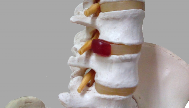腰椎椎間板ヘルニアによる坐骨神経痛